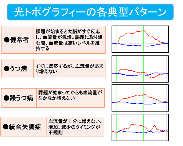 光トポグラフィー検査